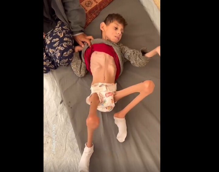 Video: 9-y-o Palestinian child in critical condition, blind and suffering from severe malnutrition and dehydration