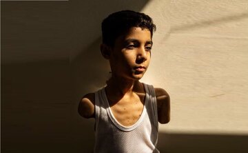 تصویر کودک بدون‌دست فلسطینی، بهترین عکس خبری سال ۲۰۲۵ شد + عکس