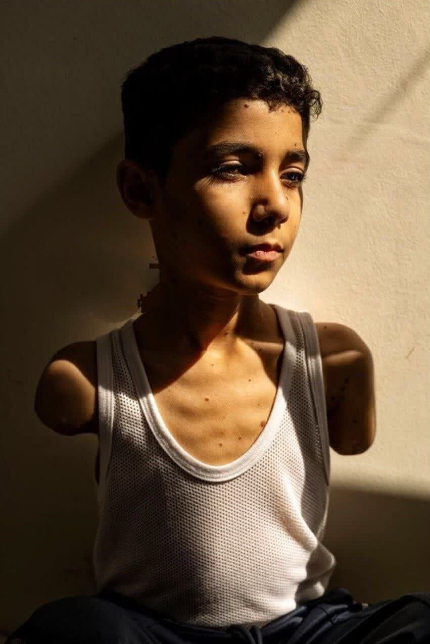 手のないパレスチナの子ども、2025年の最優秀報道写真に選出 + 写真