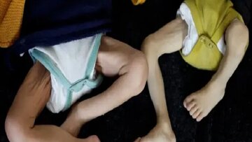 Kematian Bayi akibat Kekurangan Gizi di Gaza Semakin Parah