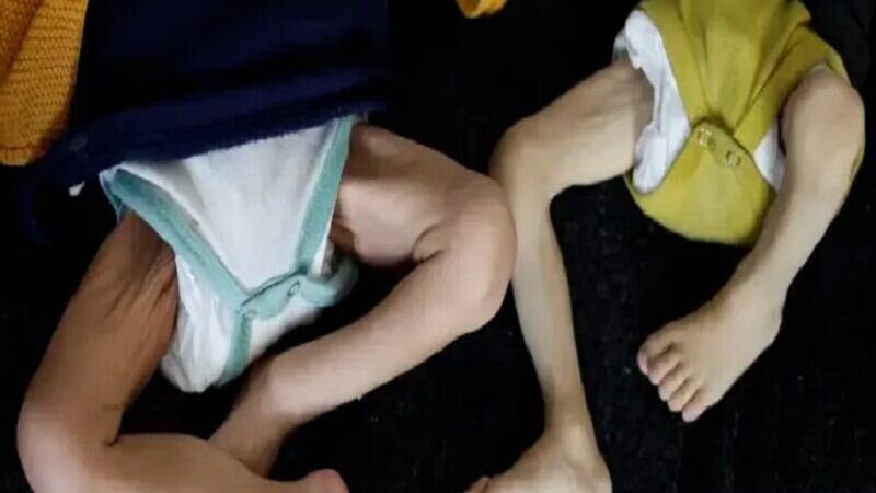 Kematian Bayi akibat Kekurangan Gizi di Gaza Semakin Parah