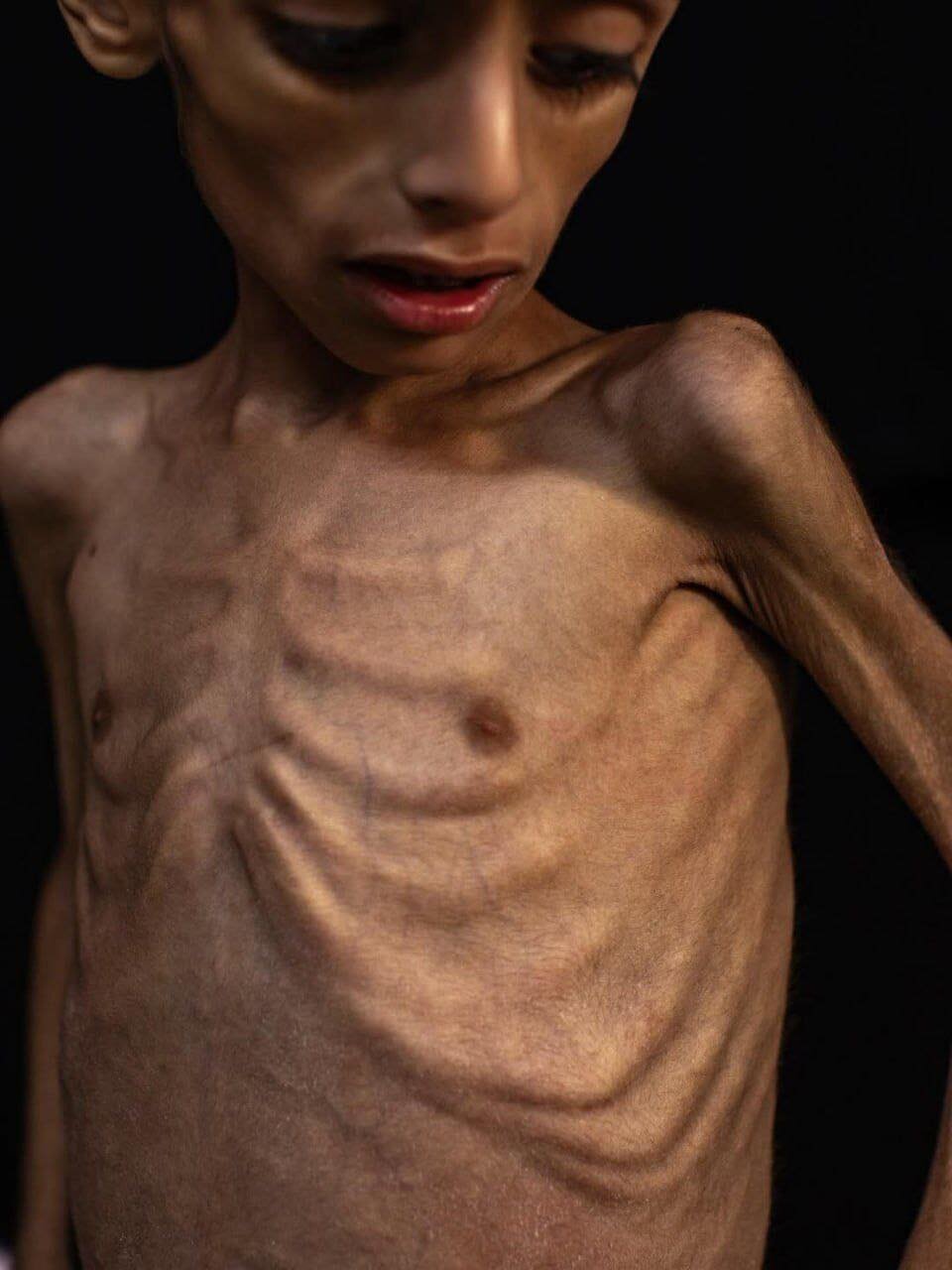 Un niño de Gaza se convierte en esqueleto viviente por el hambre bajo el asedio israelí