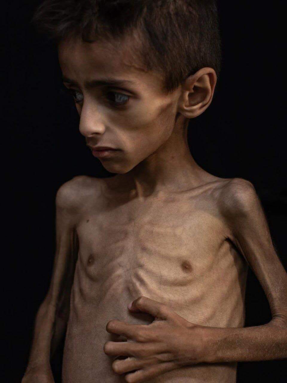 Un niño de Gaza se convierte en esqueleto viviente por el hambre bajo el asedio israelí