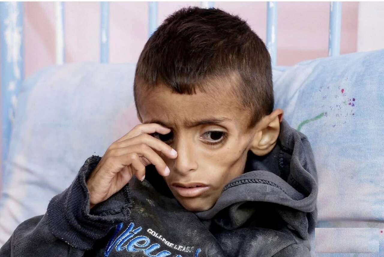 Un niño de Gaza se convierte en esqueleto viviente por el hambre bajo el asedio israelí
