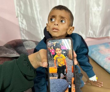 Un niño de Gaza se convierte en esqueleto viviente por el hambre bajo el asedio israelí