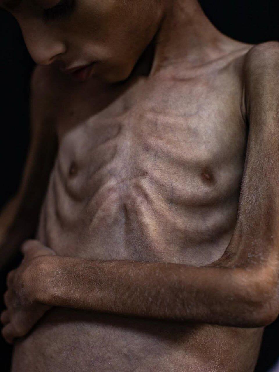 کودک غزهای از گرسنگی به اسکلت تبدیل شد + تصاویر
