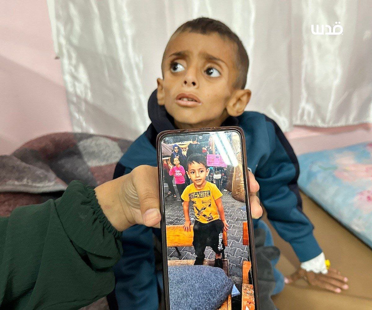 کودک غزه‌ای از گرسنگی به اسکلت تبدیل شد + تصاویر