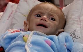UNICEF: Milhares de bebês em Gaza sofrem de desnutrição e falta de acesso à nutrição adequada