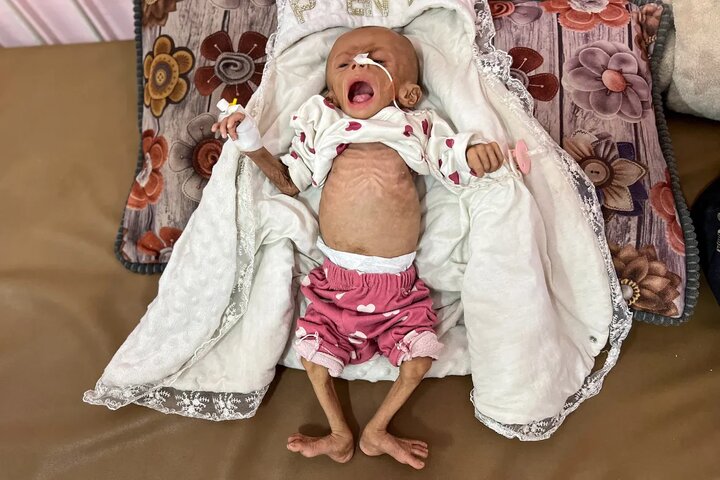 الجوع في غزة