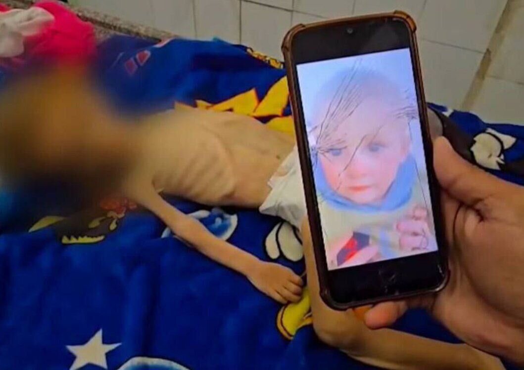 شهادت ۶۹ کودک در غزه به دلیل سوءتغذیه