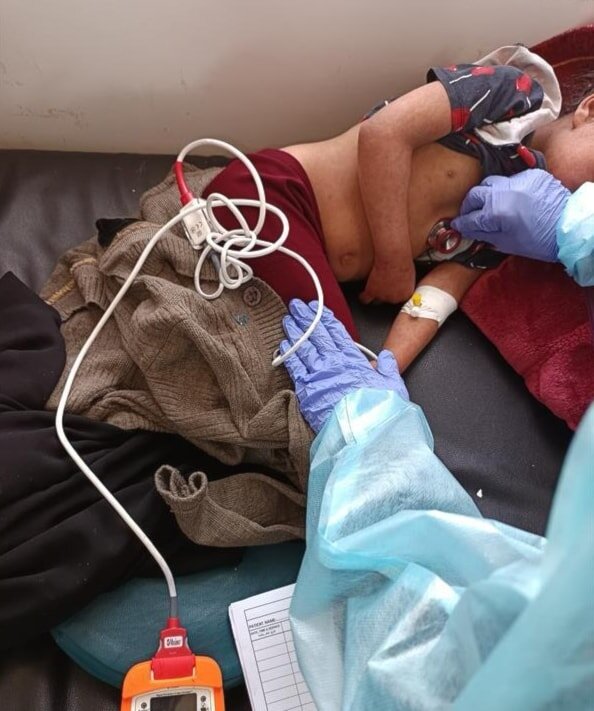 کودکان یمنی قربانی جنگ و بیماری/ شیوع گسترده سرخک در استان ذمار یمن