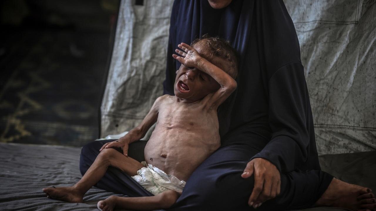 سوءتغذیه شدید ۱۷ هزار کودک فلسطینی