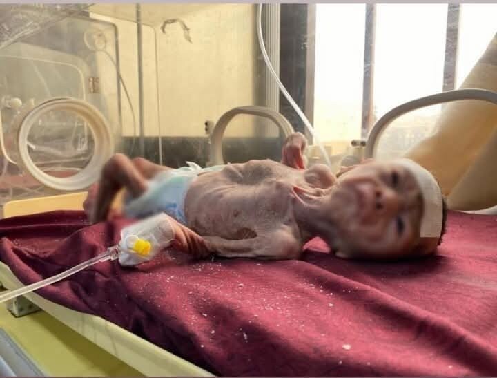 Gaza health ministry reports five starvation deaths, including two children