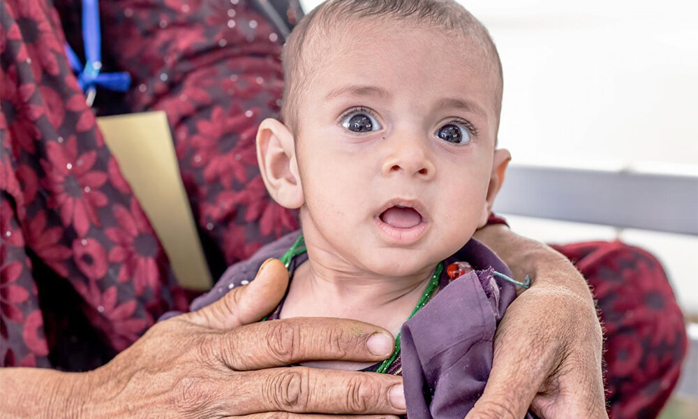 سوءتغذیه و سرخک بلای جان کودکان افغان