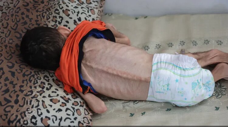 Five more Palestinians die due to starvation in Gaza