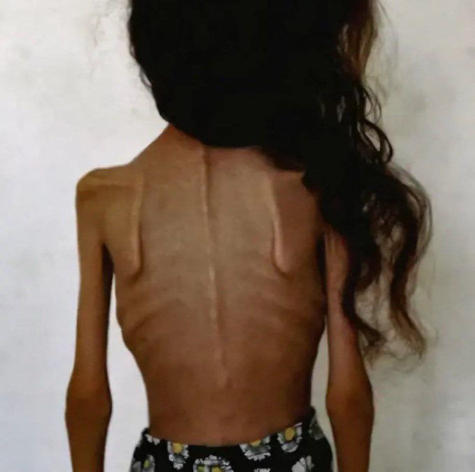 Five-year-old Muhammad Zakaria Khader dies of starvation in Khan Yunis, Gaza