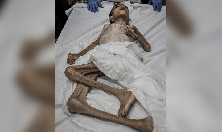 Gaza famine deaths rise to 251, including 108 children, says Health Ministry