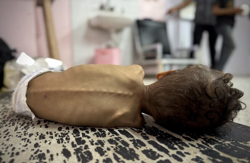 غزة: ارتفاع حصيلة ضحايا التجويع وسوء التغذية إلى 263 شخصا بينهم 112 طفلا