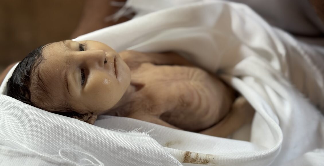 Five-month-old girl succumbs to malnutrition in Gaza