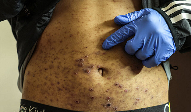 Scabies epidemic ravages Palestinian prisoners amid medical neglect in Israeli jails