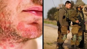 Буҳрони беҳдоштии Ғазза ؛Домангири низомиёни Исроил / Бемориҳои пӯстӣ дар миёни сарбозони саҳюнистӣ дар ҳоли шиюъ