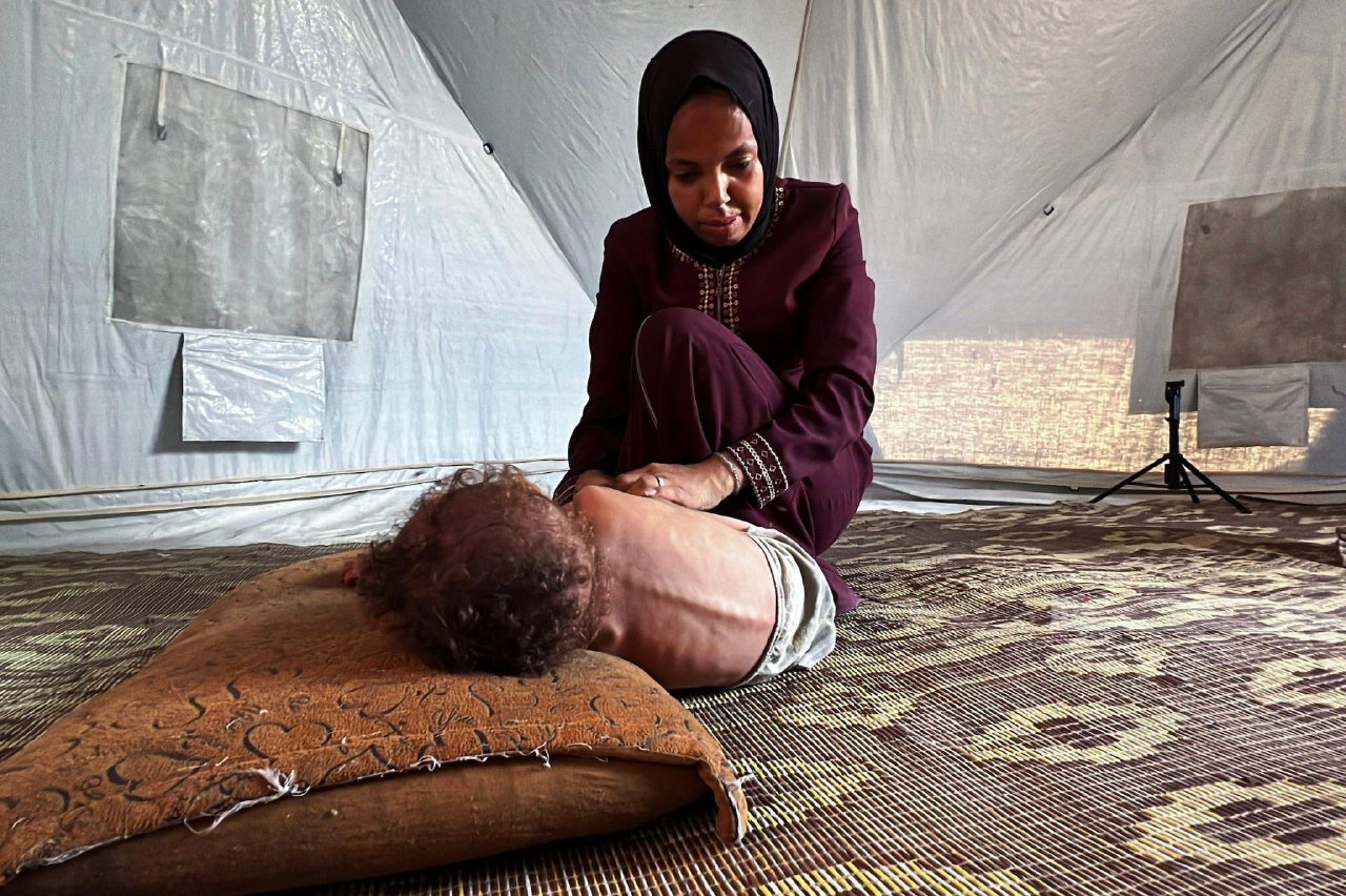 Gaza Starvation Deaths Reach 455, Including 151 Children