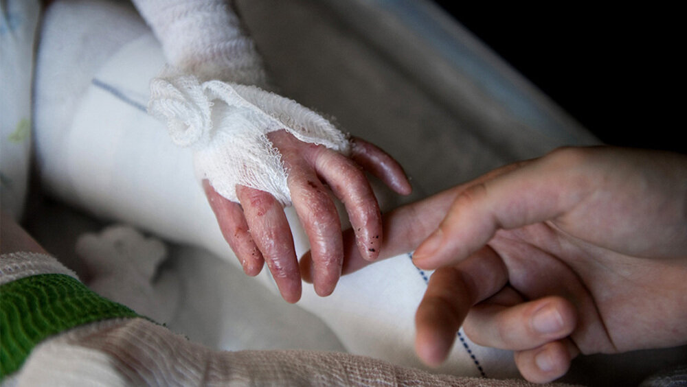 Iran Condemns US Sanctions on EB Patients as ‘Cruel and Inhumane’