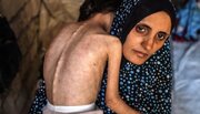 UNICEF: Nutrition screenings in Gaza show 9,300 Palestinian children under 5 suffered acute malnutrition in October