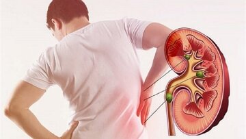 Şîret bo kesên ku kevir li gurçikên wan çê dibin