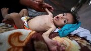 WHO: Over 100,000 children in Gaza at risk of severe malnutrition by next April