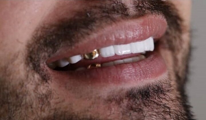 အမျိုးသားများသည် ရွှေဖုံးထားသော သွား (Gold Cap) ဖြင့် နမာဇ် ဝတ်ပြုခြင်းသည် ပိုင်ပါသလား?