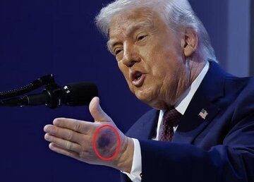 Pagdududa tungkol sa kalusugan ni Trump; ang doktor ni Dick Cheney ay humiling ng mga medikal na sagot