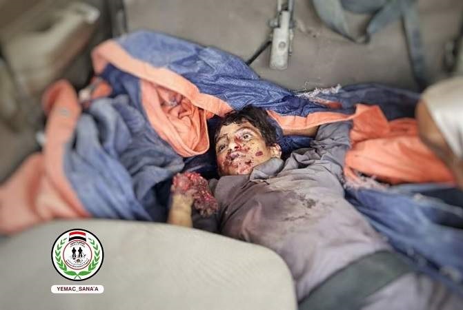  إصابة طفلين بانفجار جسم من مخلفات العدوان بصعدة