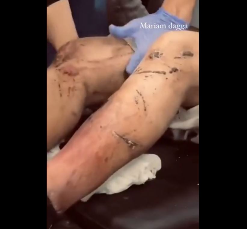 Video: Several Gaza detainees released by Israeli Occupation after severe beatings and torture