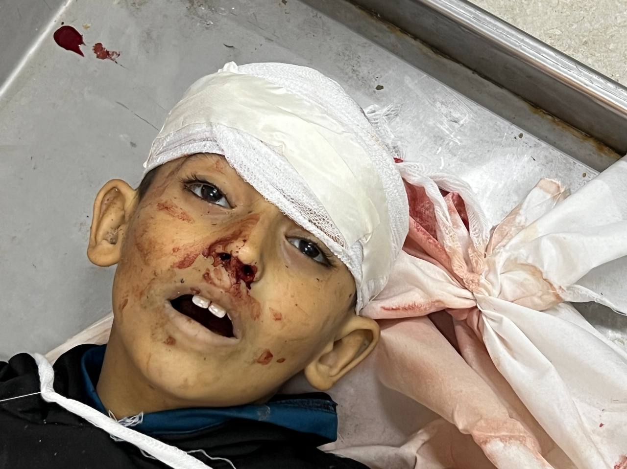 Death toll from Israeli attacks on Gaza 20,915 and injured 54,918 