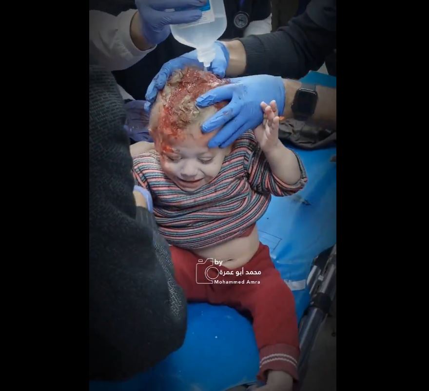 Video: Another child targeted by Israeli occupation warplanes in Rafah, Gaza