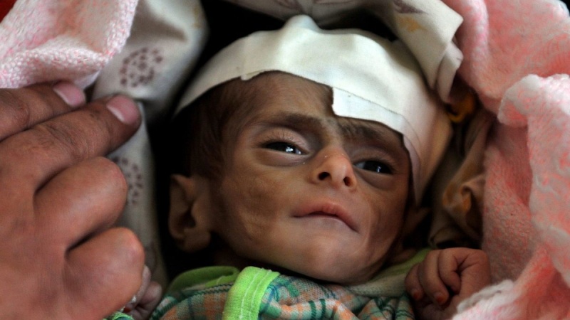 Mehr als 250 Millionen Menschen weltweit 2022 von akutem Hunger und Hungertod bedroht