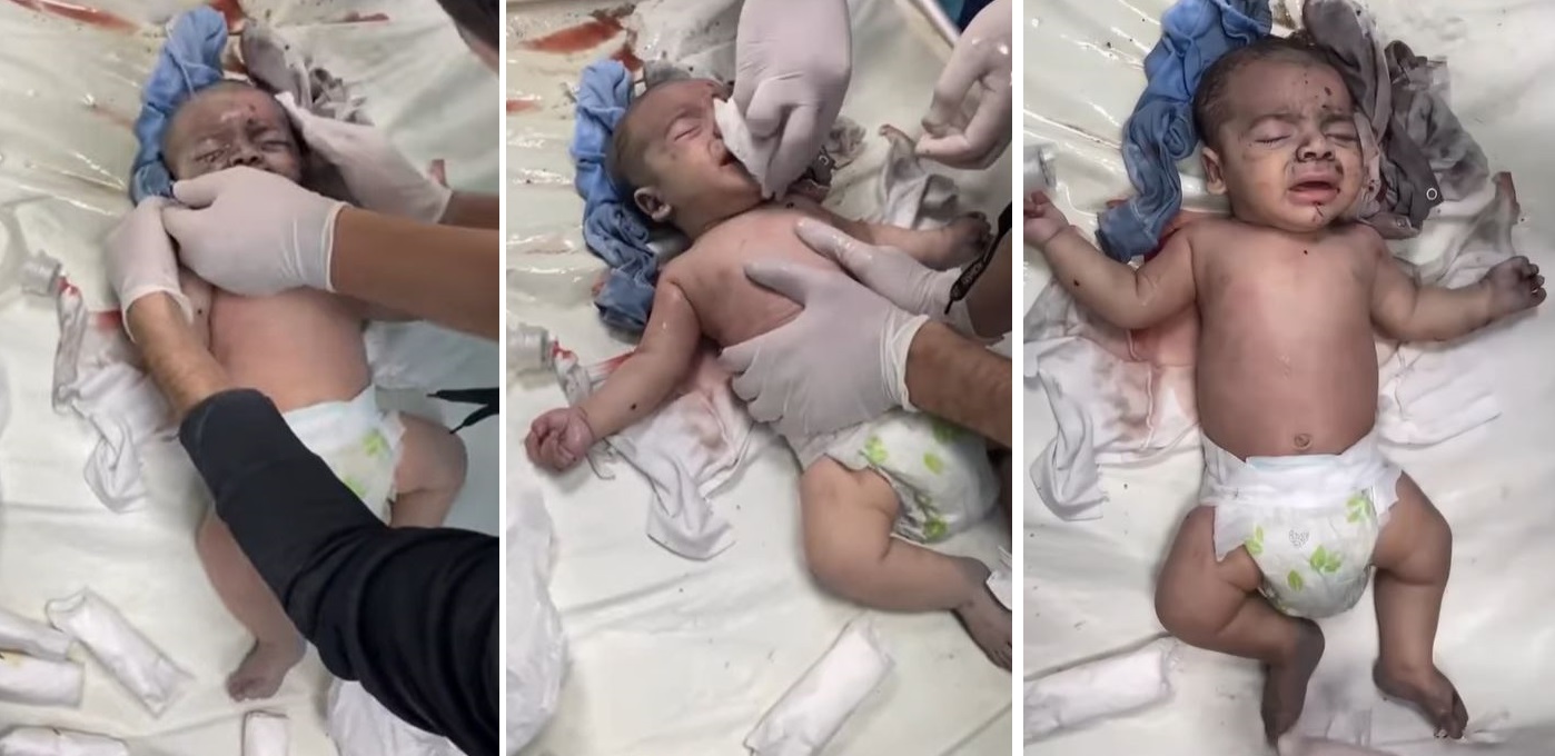 Video +14: Palestinian infant injured in due to Israeli warplanes bombardment of Gaza homes