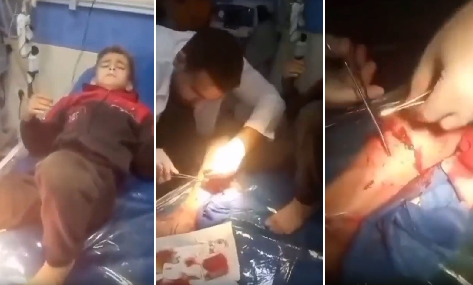 Video: A child, critically wounded in Israeli airstrike reciting Quran  to face pain of surgery without anesthesia