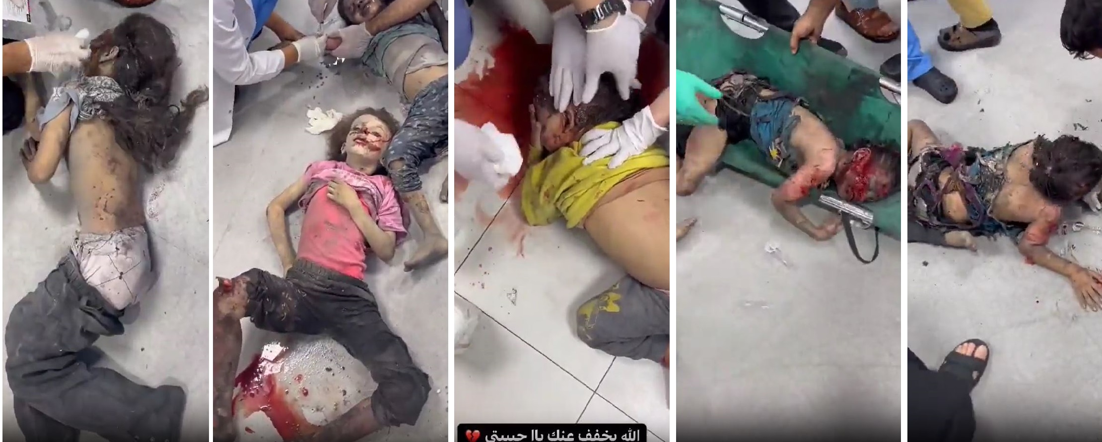 GRAPHIC Video: Mutilated limbs, burns, amputations... of these children in Israeli genocide campaign today