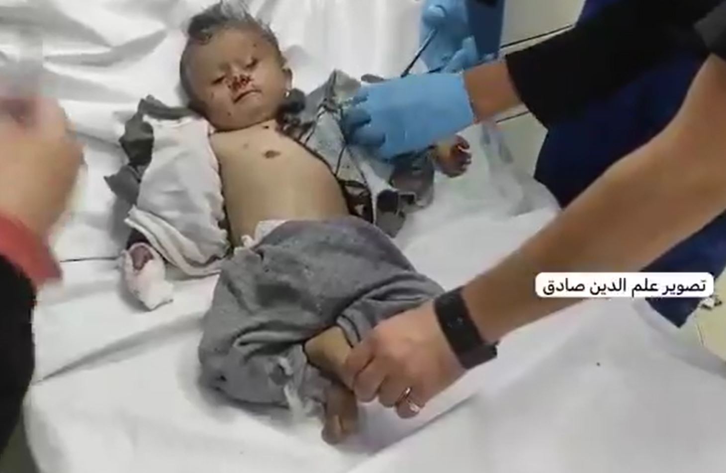Video: Palestinian infant injuried in Israeli airstrike targeted a tent in Al-Mawasi, southern Gaza 