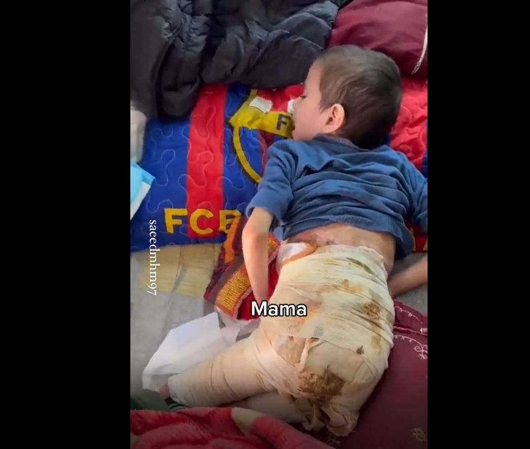 Video: Palestinian child unbearable pain after suffering third-degree burns from Israeli airstrike