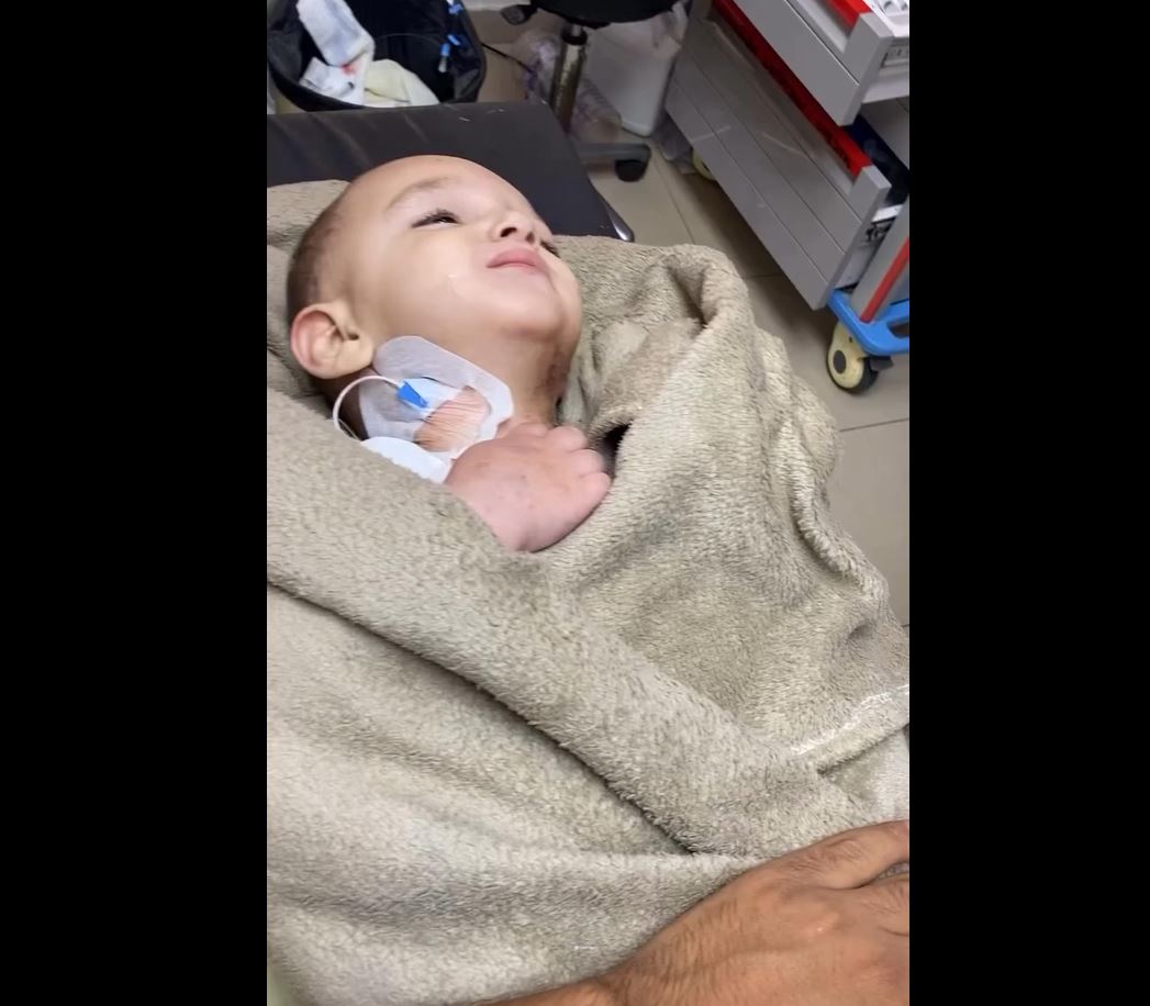 Video: A Palestinian child suffered severe burns all over his body in occupation's bombing of Gaza 