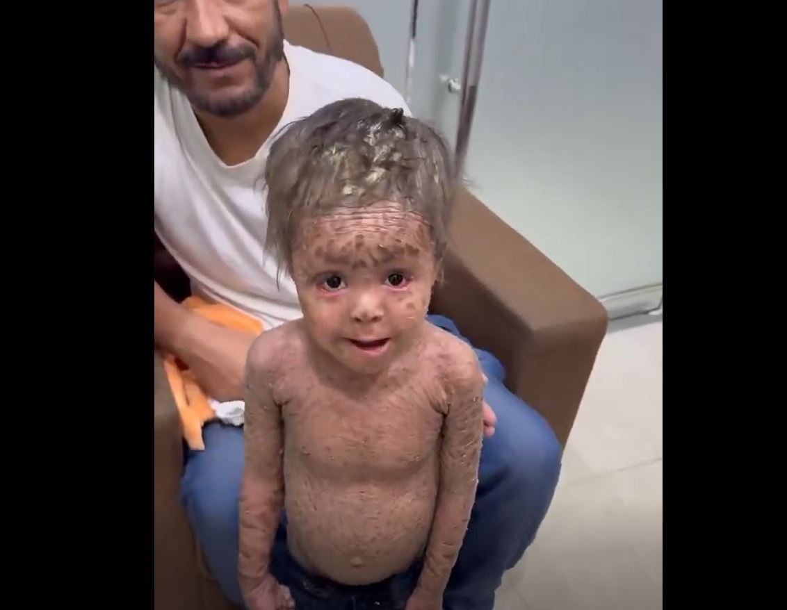 Video: Due to lack of healthcare in Gaza; Palestinian children suffering from unknown skin