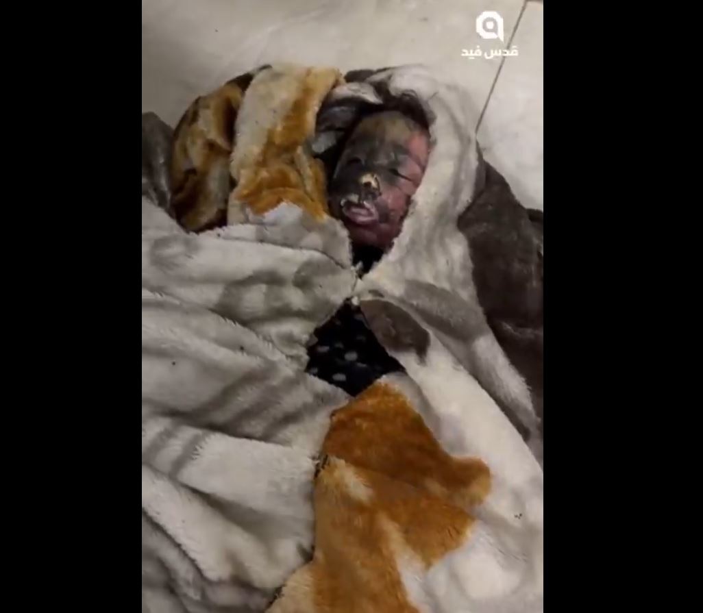 Sensitive video: A Palestinian child martyred in Israeli holocaust in Al-Mawasi of Khan Younis, southern Gaza 