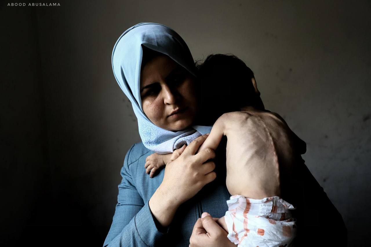 Palestinian child dies of malnutrition in Gaza, bringing martyrs of famine to 40