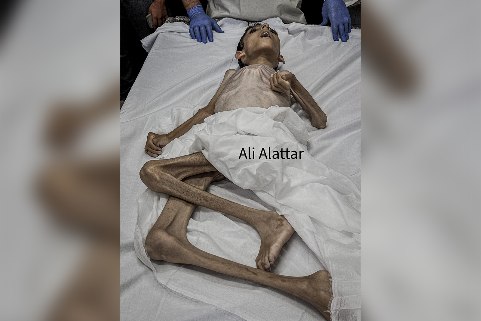 Palestinian child dies because of famine in Gaza