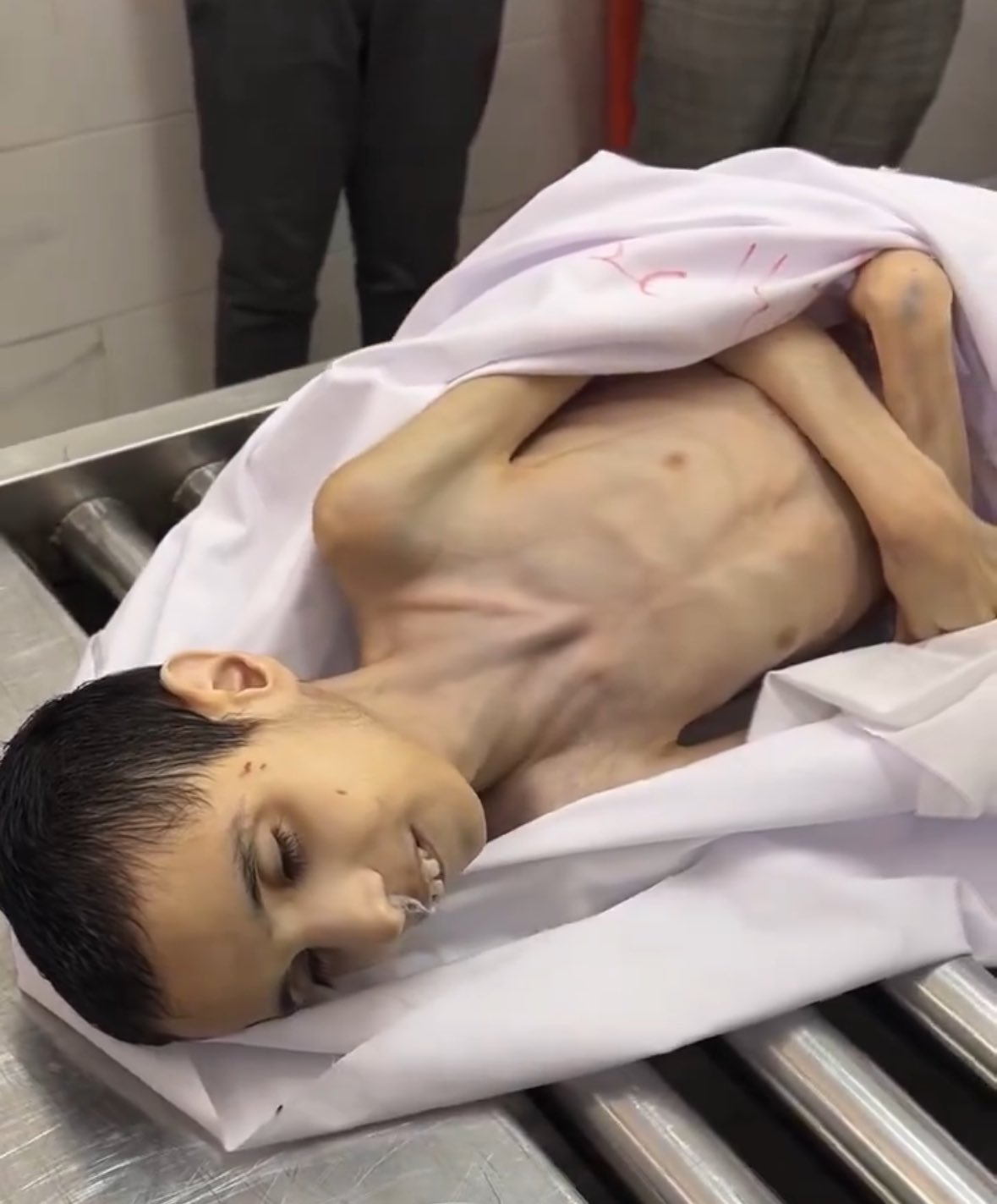 Three more children die of malnutrition and dehydration in Gaza