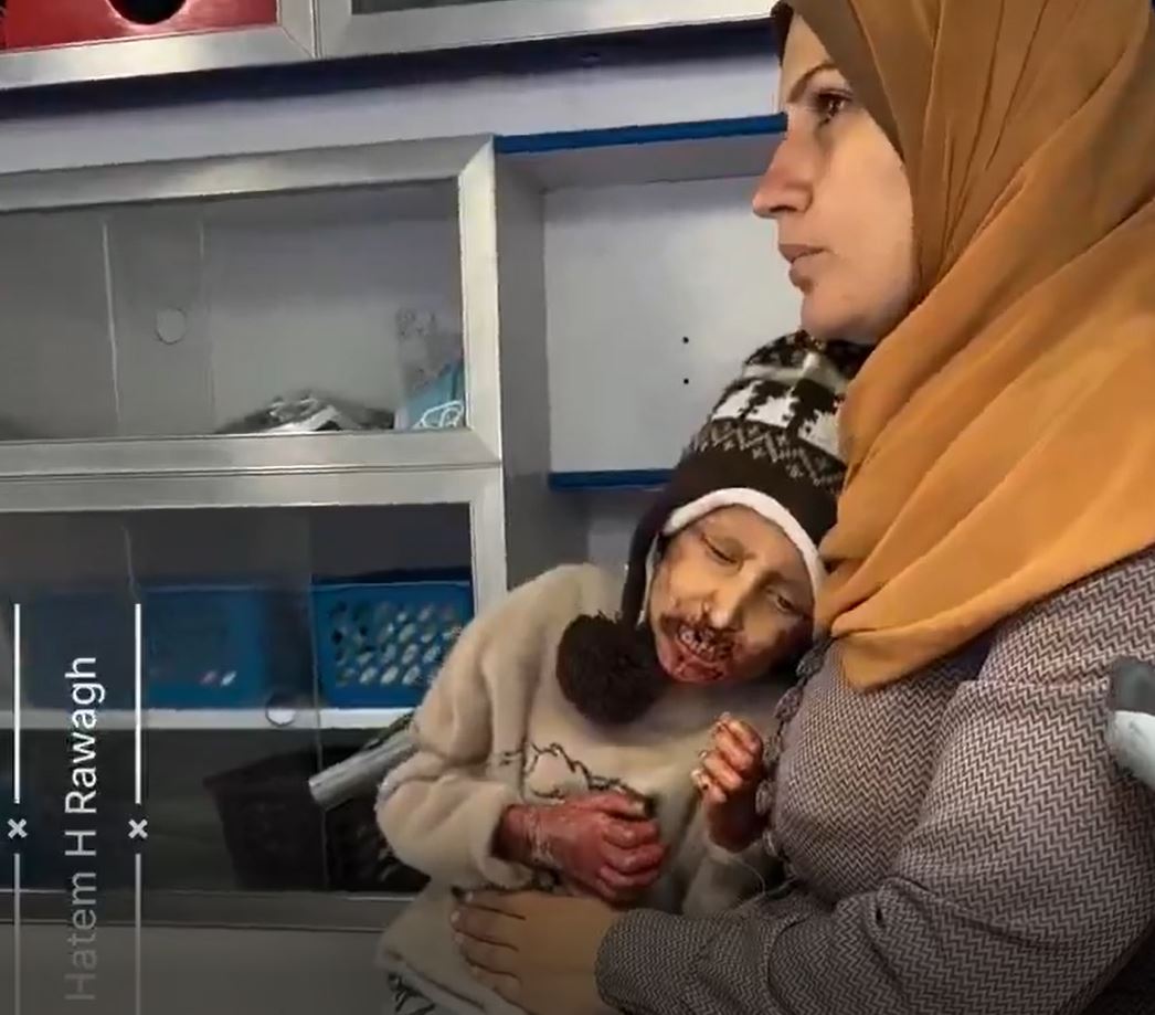 Video: Six year-old Palestinian girl seriously injured in Israelis air strike in Nuseirat, central Gaza