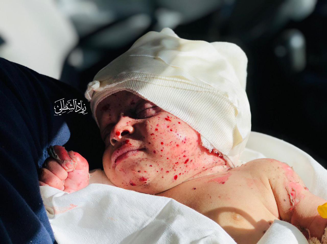 Sensitive Video: An infant injured in Israeli bombing a school in Nuseirat, central Gaza